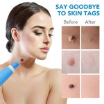 Auto Skin Tag Remove Kit