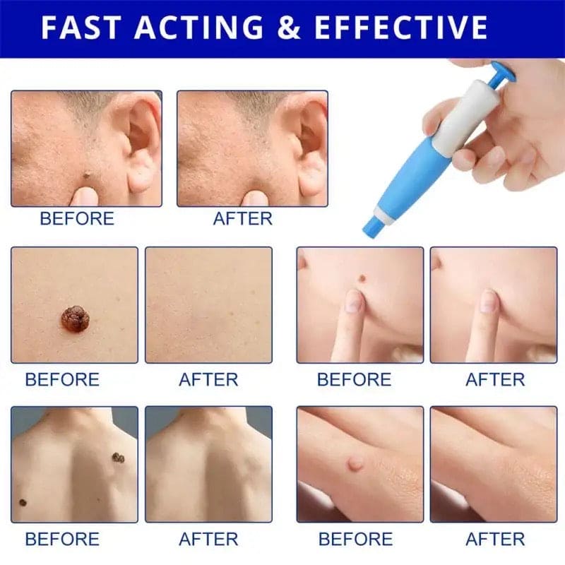 Auto Skin Tag Remove Kit