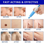 Auto Skin Tag Remove Kit