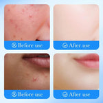 SADOER Acne Patch Repair Acne Skin Promote Healing Salicylic Acid Quick Soothing Non-Drying 1 patch in Box