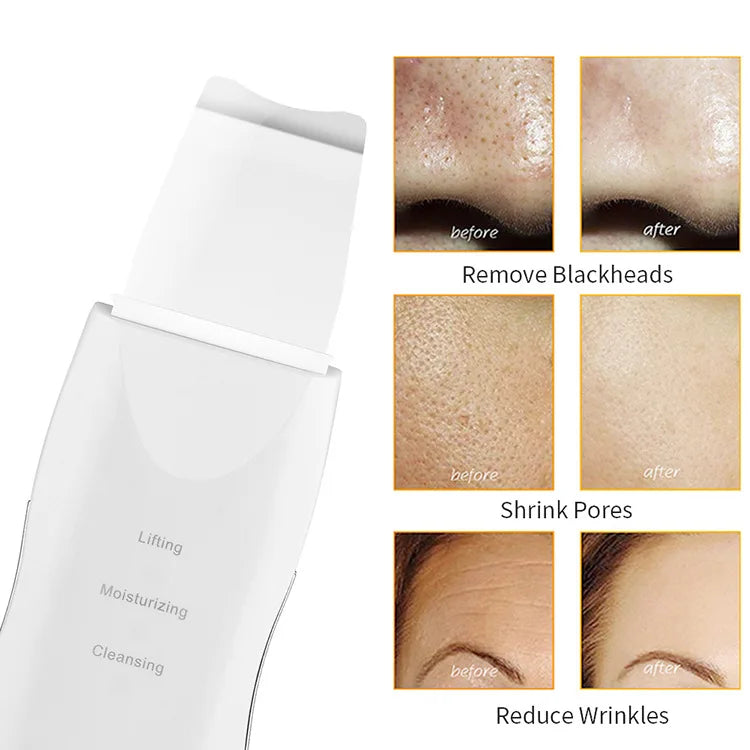 Home Face Pore Cleaning Massage Spatula Machine Exfoliating & Suctioning Blackheads & Acne