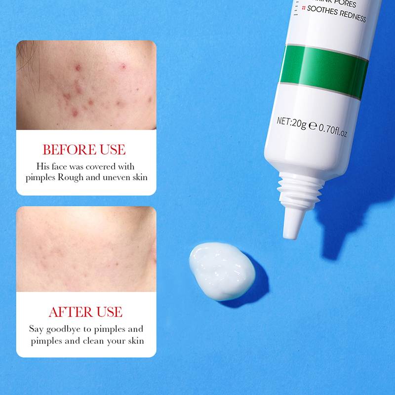 Bioaqua Salicylic Acid Acne Removal Cream 20g