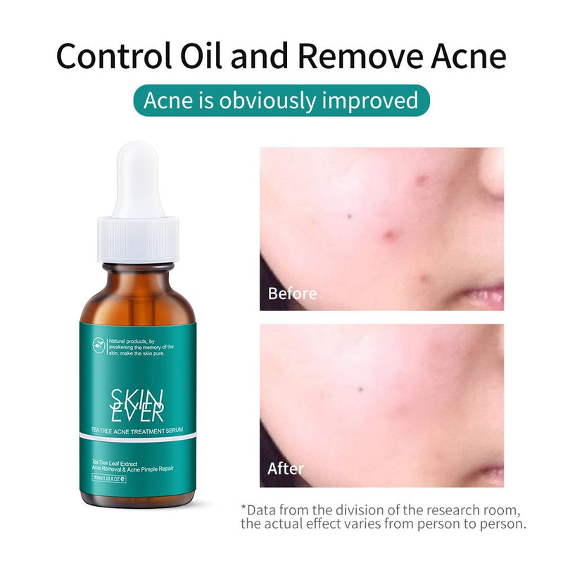 Skin Ever Tea Tree Acne Treatment Serum