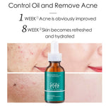 Skin Ever Tea Tree Acne Treatment Serum
