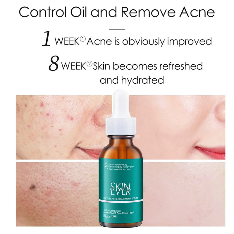 Skin Ever Tea Tree Acne Treatment Serum